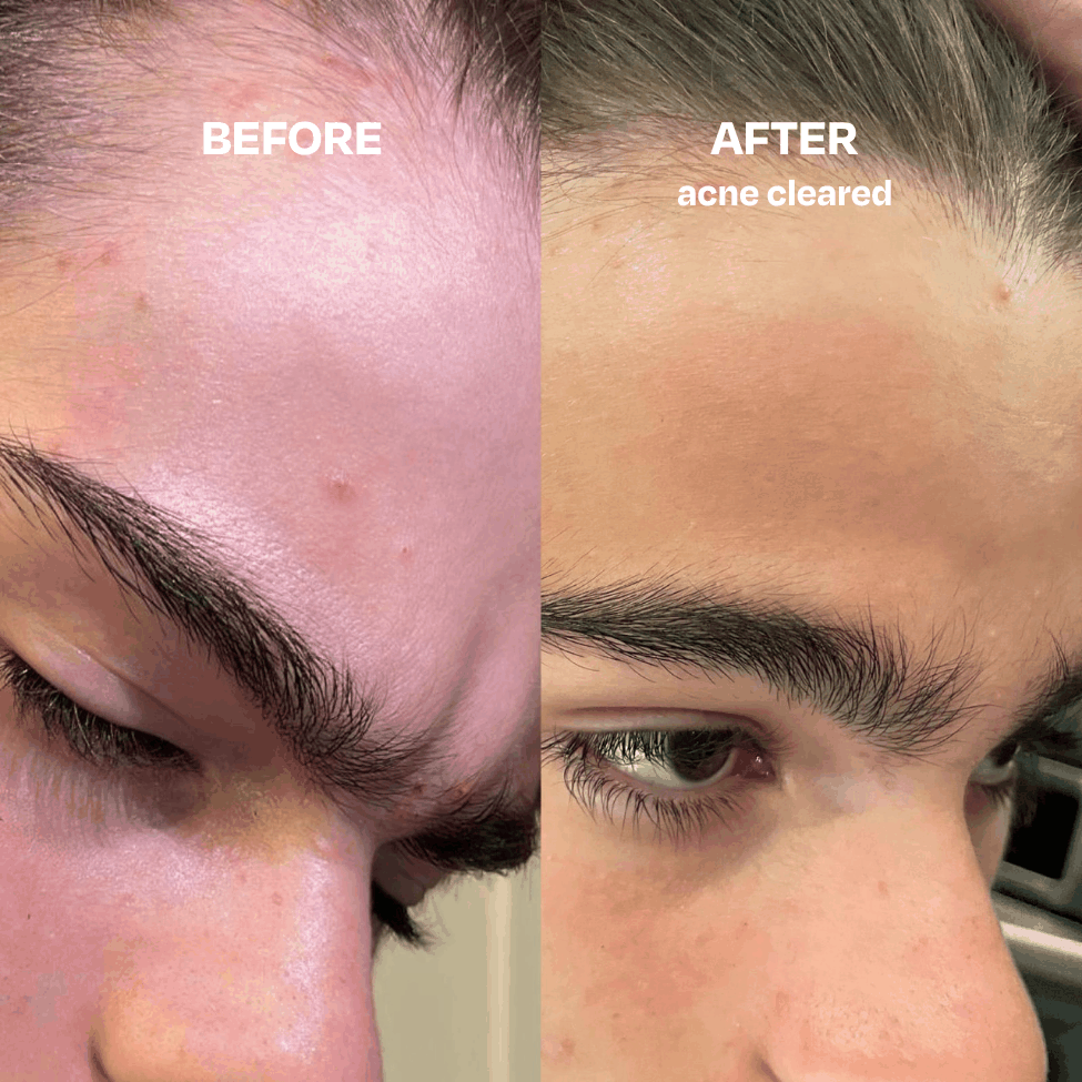 Skin Saver for Tweens