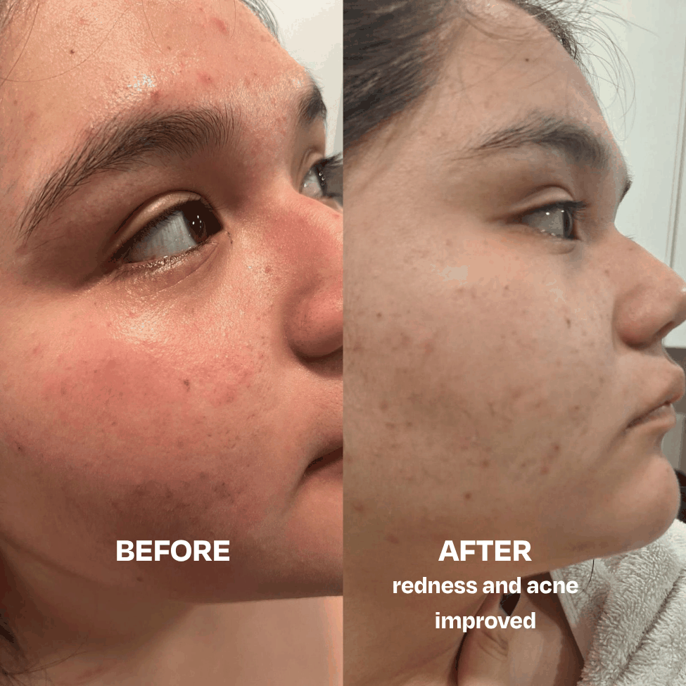 Skin Saver for Tweens